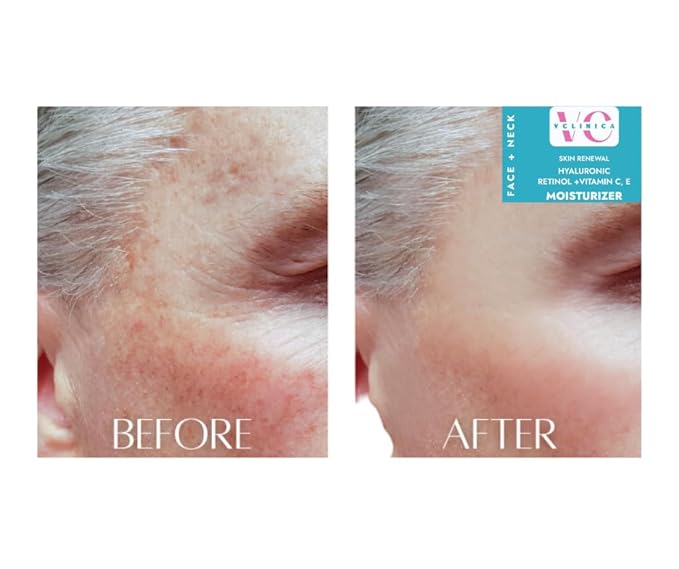 Hyaluronic Moisturizer with Retinol