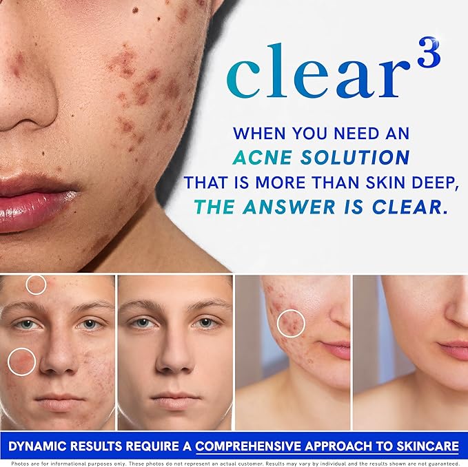 Clear Skin Acne Supplement with Zinc, DIM & Probiotics | 3-in-1 Balance, Clarify, Restore Support with Hyaluronic Acid & Skin Support Vitamins | for Women & Men | Oral Hormonal Acne Pills | 120 Ct